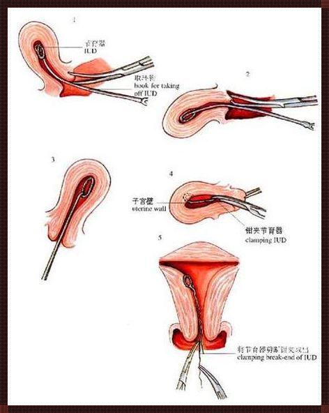 《给m穿孔上环，潮流背后的健康密码》